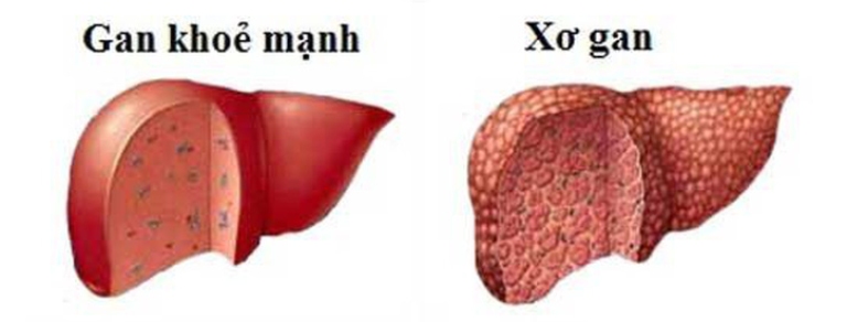Xơ gan giai đoạn cuối là tình trạng phần lớn tế bào gan khỏe mạnh đã được thay thế bằng mô xơ