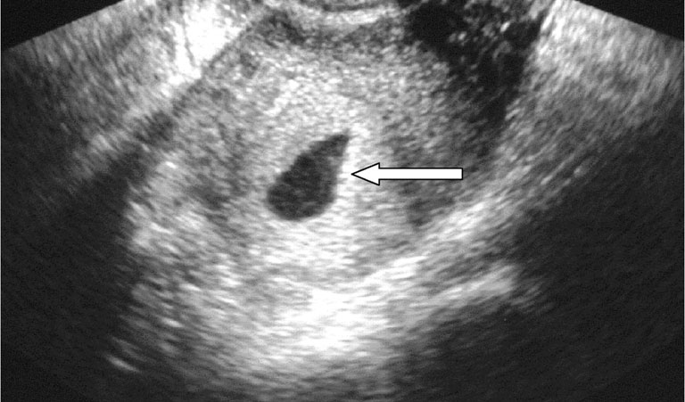 Hình ảnh siêu âm thai ngoài tử cung
