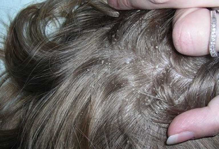 Á sừng da đầu hình thành trên bề mặt da các lớp vảy gây bong tróc