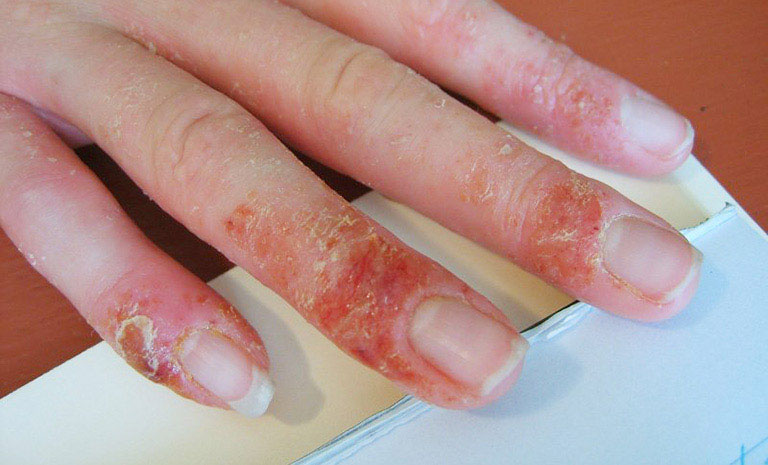 Mụn nước sau khi vỡ sẽ khô lại và gây bong tróc trên bề mặt da ở đầu ngón tay