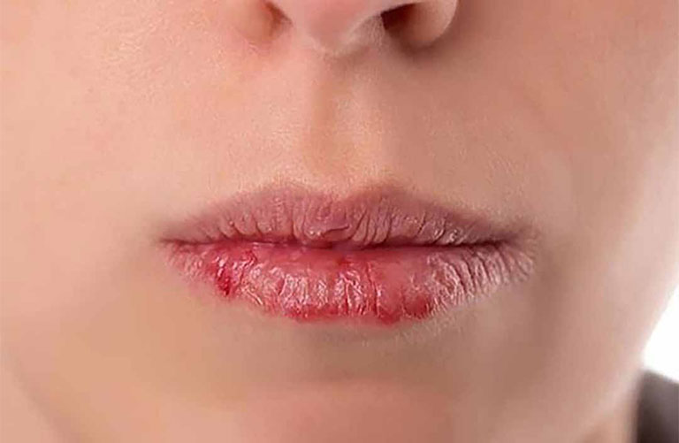 Bệnh chàm môi