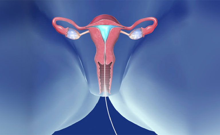 phương pháp mổ thai ngoài tử cung