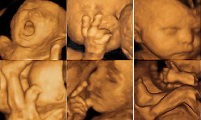 Hãy cùng xem hình ảnh siêu âm 4D 22 tuần để quan sát rõ hơn về những nét đặc trưng và sự phát triển của thai nhi.