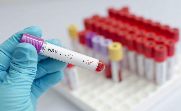 Xét nghiệm máu dương tính với virus HBV đồng nghĩa với việc bạn đã bị viêm gan B