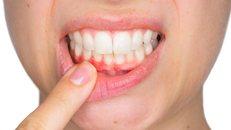 cách trị viêm nướu răng tại nhà
