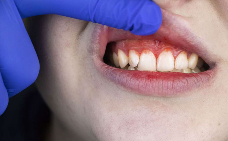 Viêm nướu có thể gây lộ chân răng