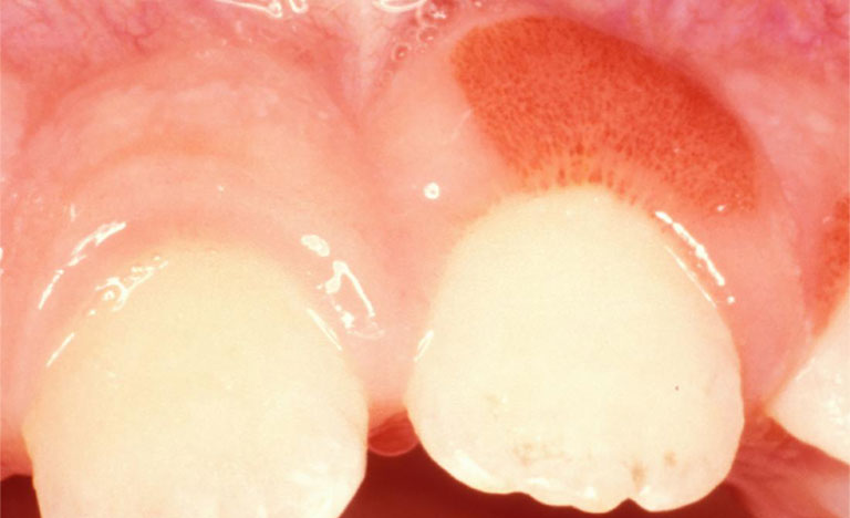 Viêm nướu dẫn đến hình thành các túi sâu giữa răng và nướu