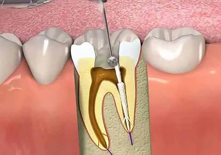 điều trị tủy cho bệnh nhân bị sâu răng