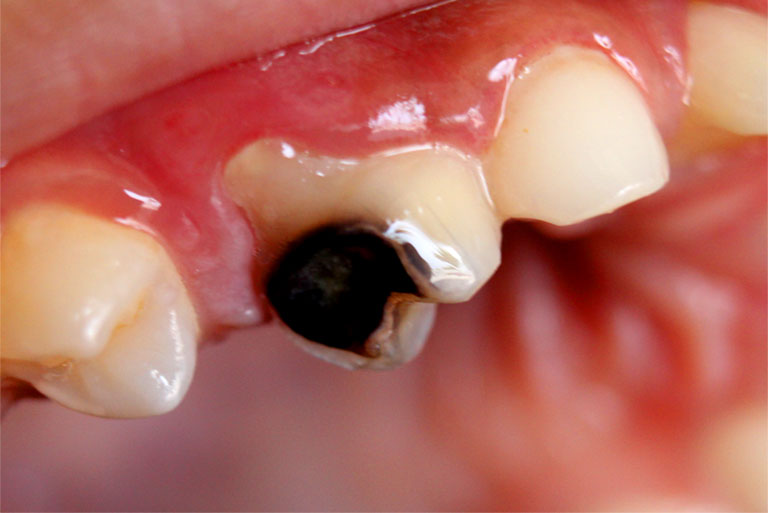 Sâu răng gây hình thành các lỗ đen trên răng