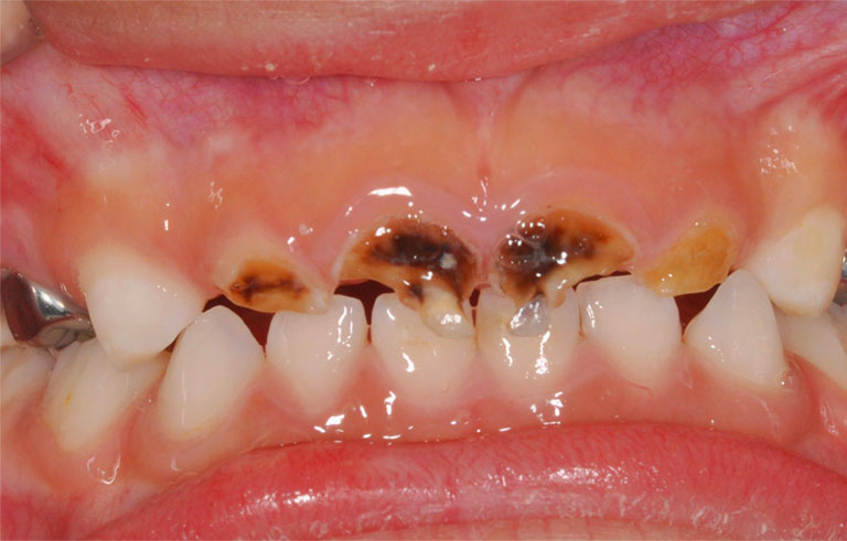sâu răng gây đớn đớn ở trẻ em 