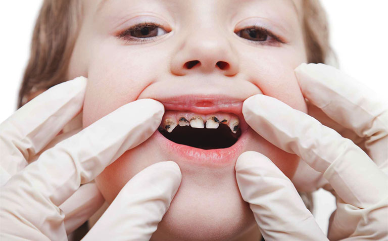 sâu răng ở trẻ em