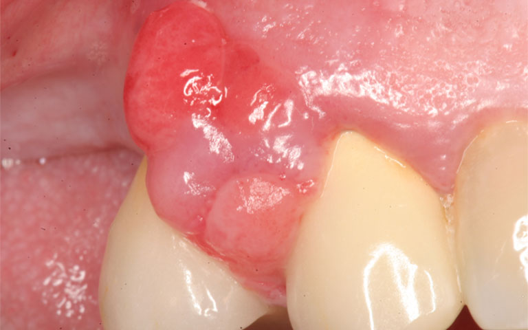 Sưng nướu răng có mủ: Nguyên nhân và cách khắc phục