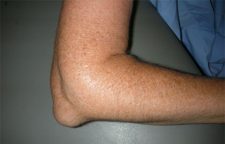 dấu hiệu viêm bao hoạt dịch khuỷu tay 