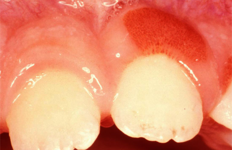 Trẻ bị viêm lợi khi mọc răng