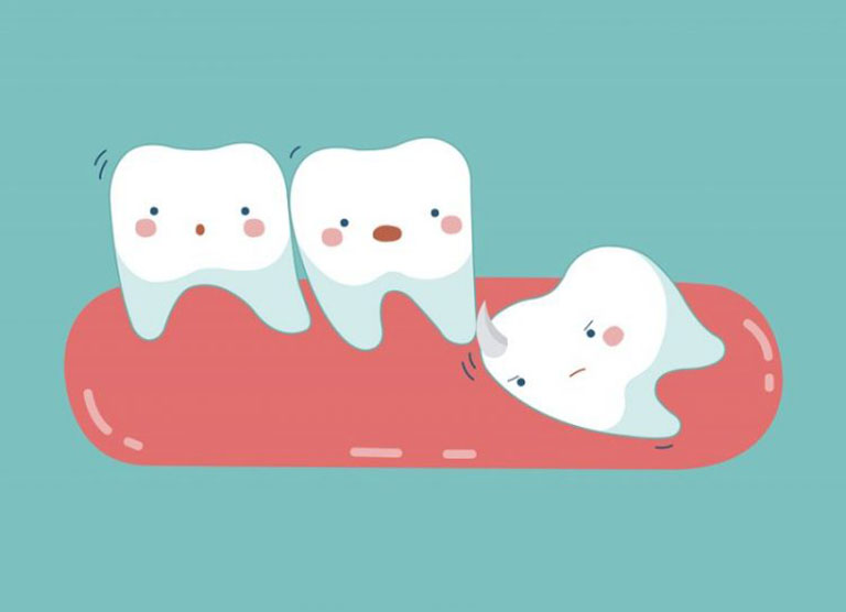 viêm lợi trùm răng khôn có mủ