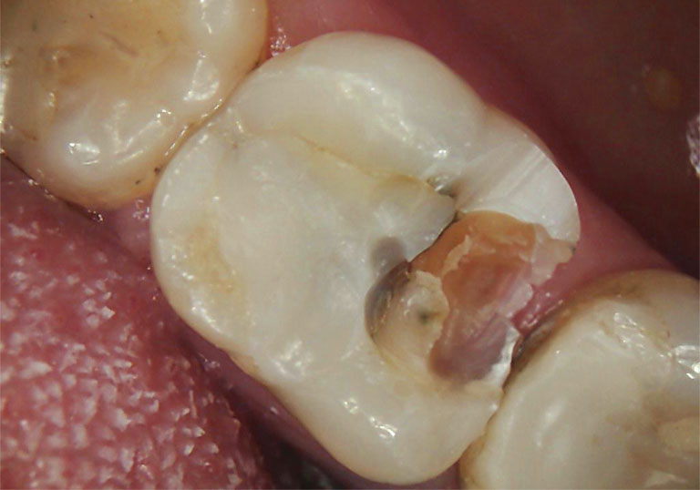 đau răng cấm nên làm gì