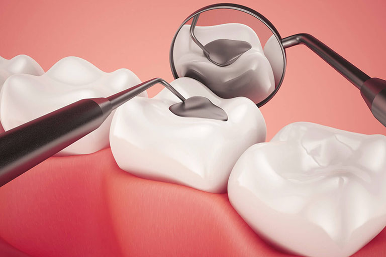 Cách chữa đau răng hàm
