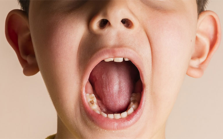 nhức răng ở trẻ em