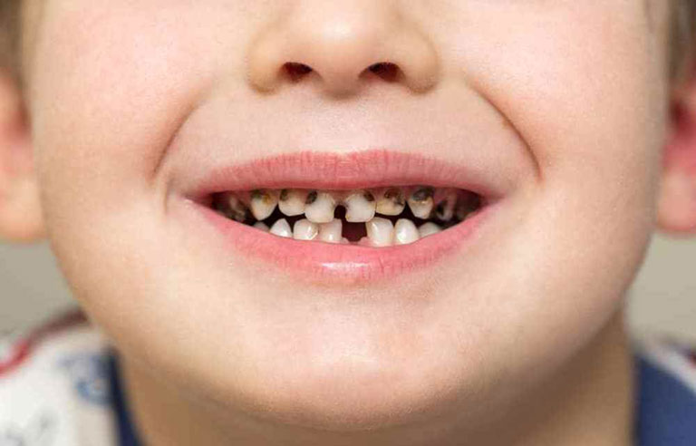 cách trị bệnh đau răng ở trẻ em