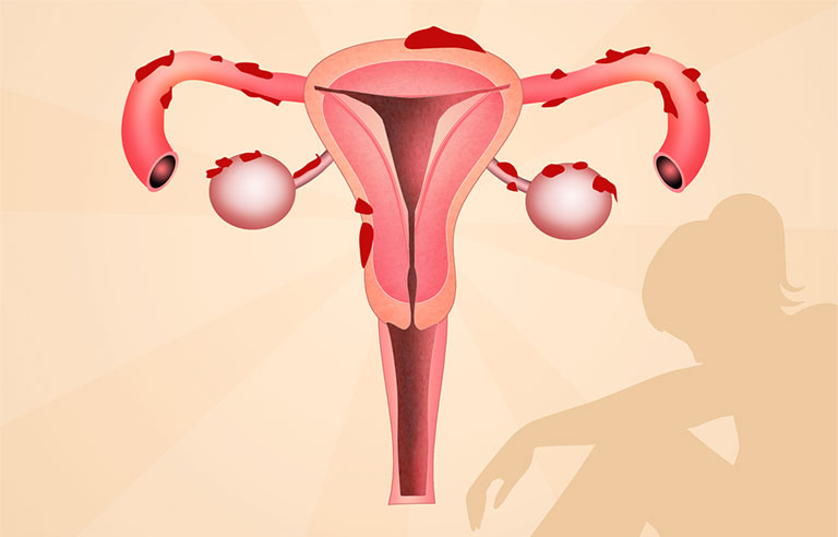 Lạc nội mạc tử cung là gì