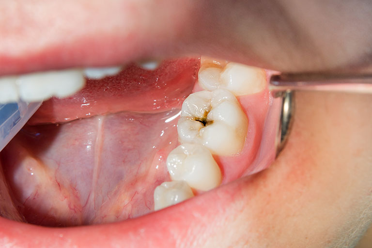 răng cấm bị sâu có trám được không