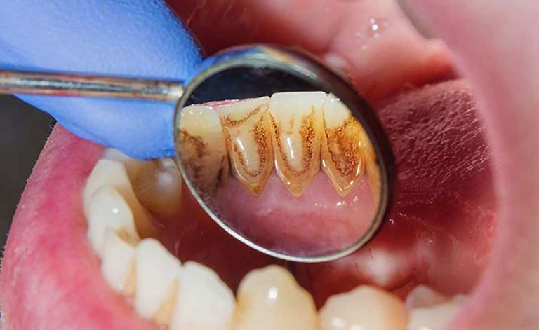 Răng hàm bị sâu chỉ còn chân răng