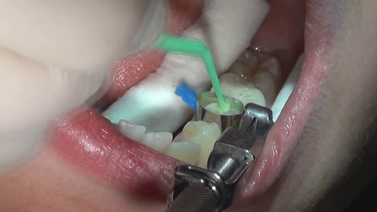 trị răng sâu nhẹ bằng trám răng