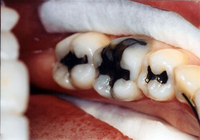 Sâu răng hàm