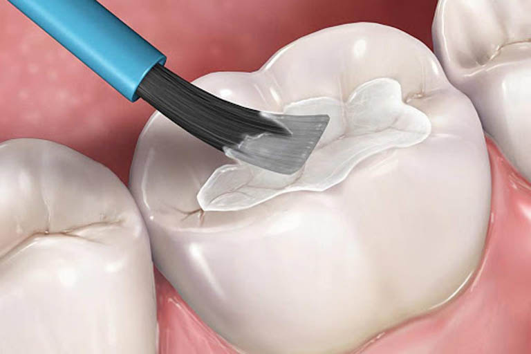 cách điều trị sâu răng hàm