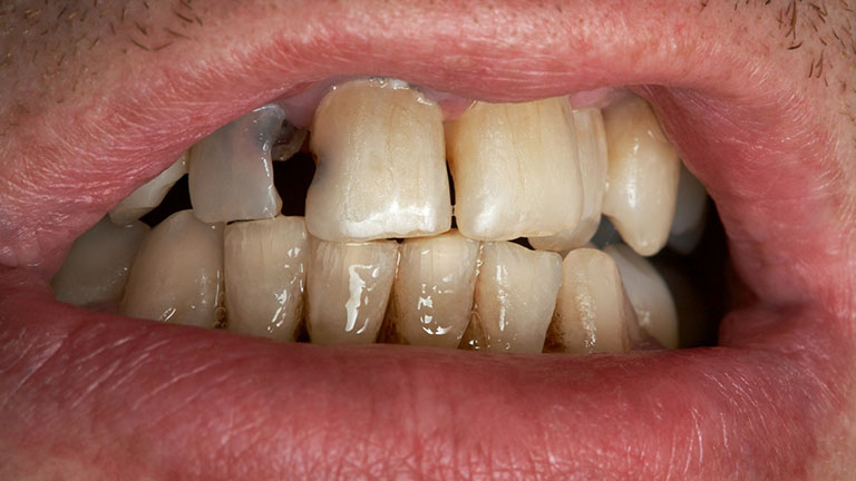 Sâu răng sưng lợi có mủ 