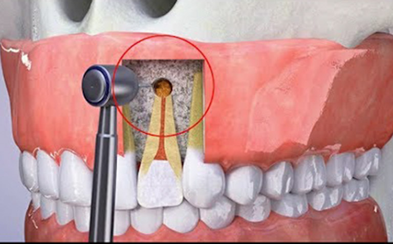 điều trị sâu răng vào tủy