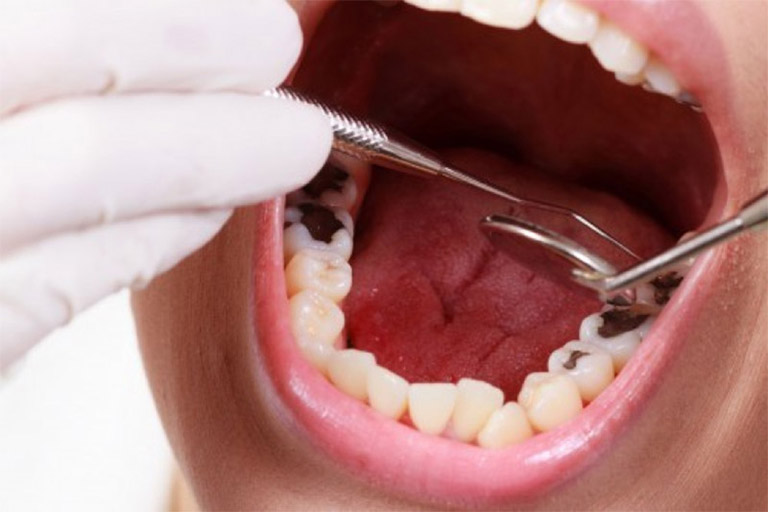 quy trình trám răng sâu