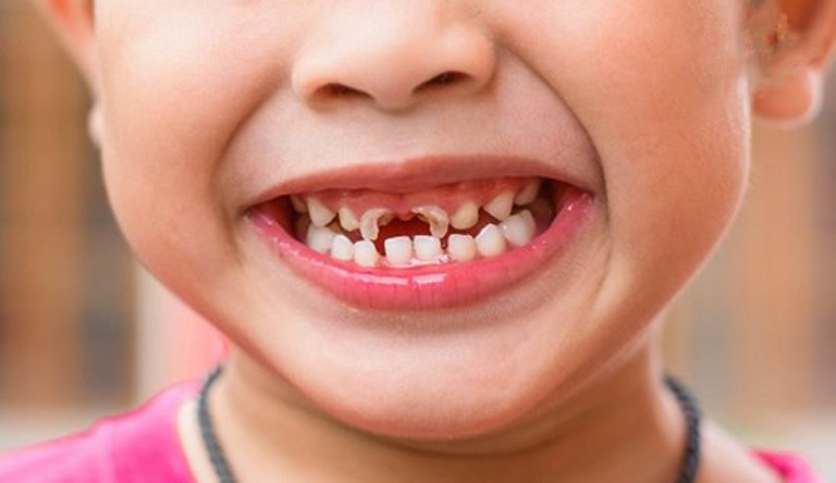 Sâu răng ở trẻ em không tiến hành điều trị đúng cách từ sớm sẽ gây phá hủy cấu trúc răng