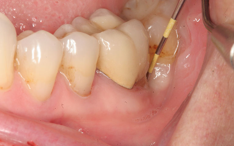 Hình ảnh áp xe răng gây tổn thương nướu