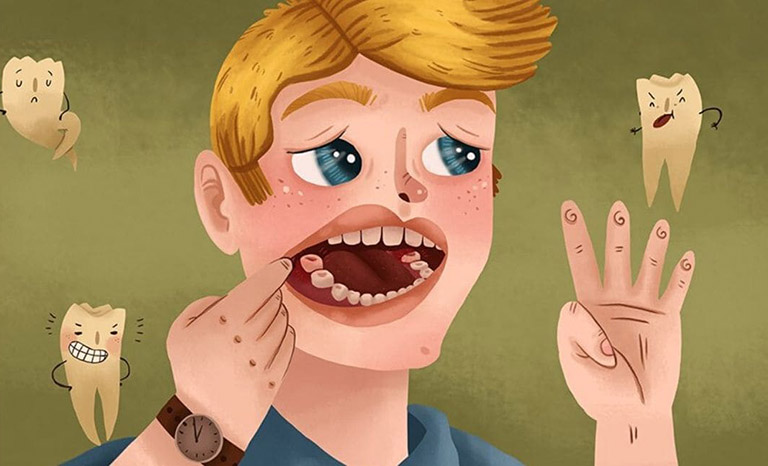 áp xe răng khôn là gì