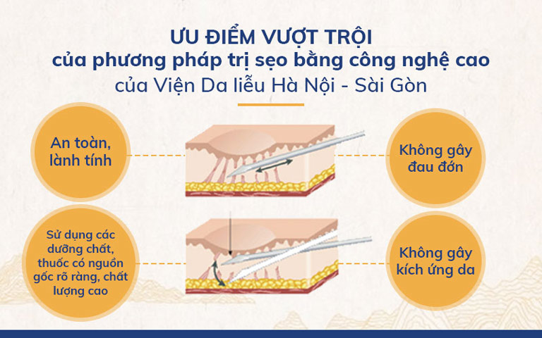 Những ưu điểm vượt trội của phương pháp tách đáy sẹo tại Viện Da liễu Hà Nội - Sài Gòn