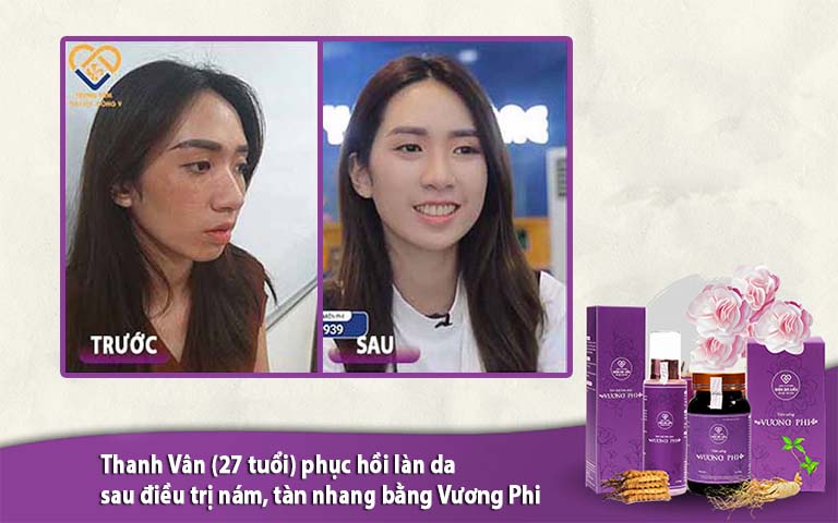 Hình ảnh khách hàng TRƯỚC - SAU điều trị nám bằng Vương Phi (được cung cấp bởi Trung tâm Da liễu Đông y Việt Nam)