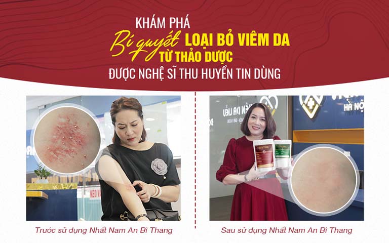Nghệ sĩ Thu Huyền lấy lại tự tin sau 2 tháng trị viêm da với Nhất Nam An Bì Thang