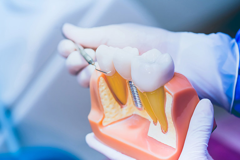 Bảng giá trồng răng Implant mới nhất