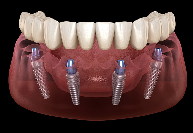 Cấy ghép Implant toàn hàm