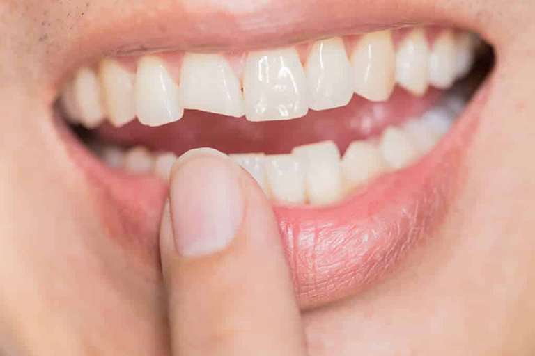 Giá trám răng cửa bao nhiêu?