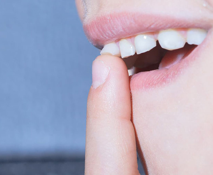 Răng bị lung lay là một trong những trường hợp không nên bọc răng sứ