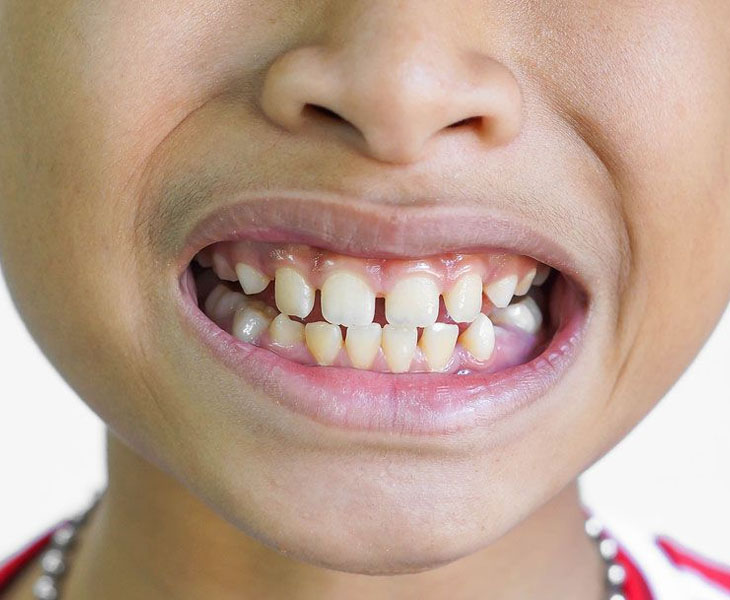 Trẻ em dưới 17 tuổi không nên bọc sứ để tránh răng suy yếu