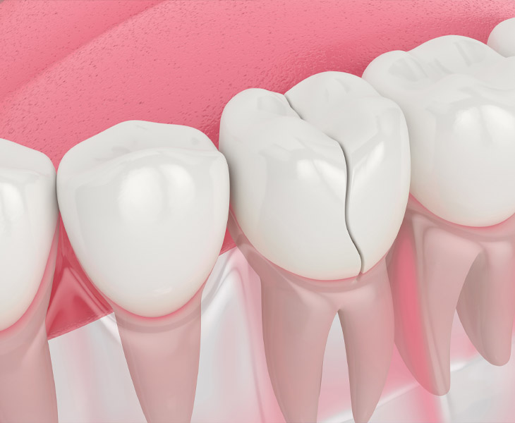Bọc sứ sai chỉ định có thể khiến răng bị nứt vỡ