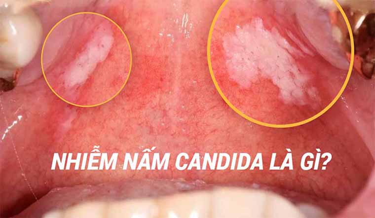 benh-nam-candida