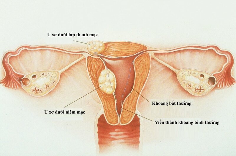 u-xo-tu-cung-lanh-tinh