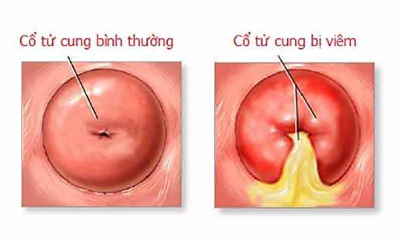 viem-co-tu-cung